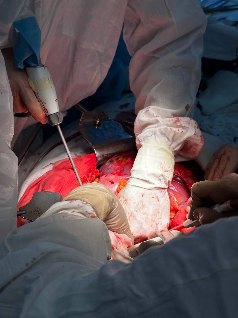 Операция по удалению опухоли