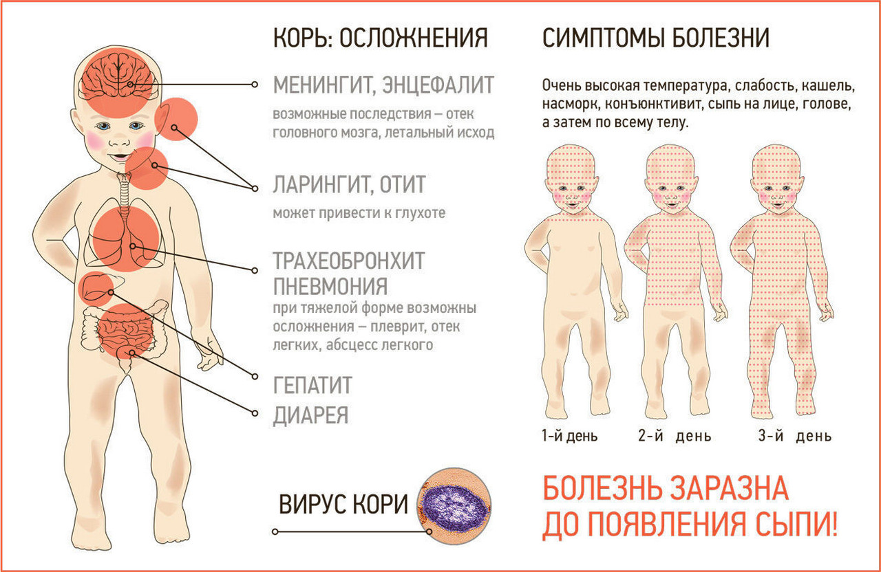 Три случая заболевания корью выявили в этом году в Красноярском крае