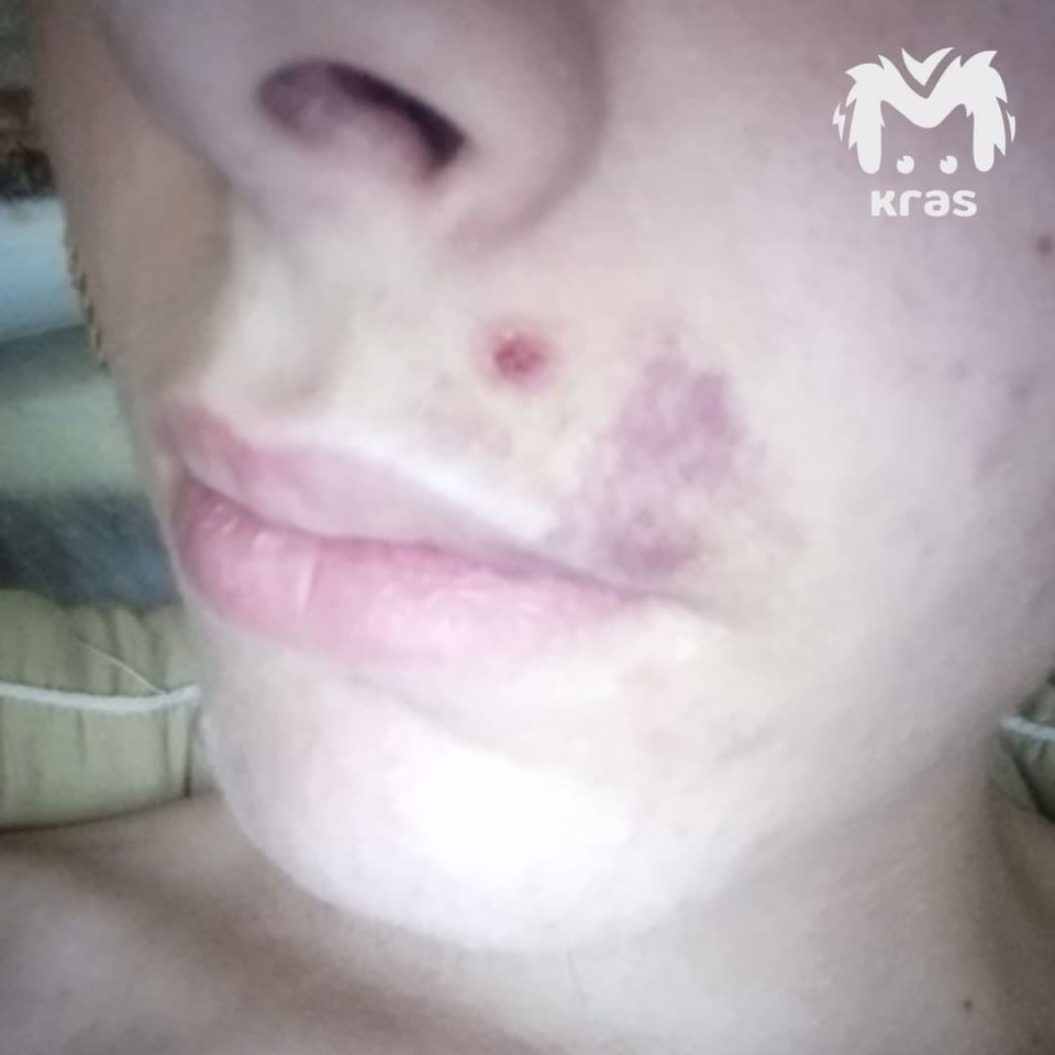 В Минусинске подростку прострелили губу